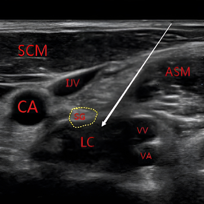 New PTSD treatment Learn about Stellate Ganglion Blocks