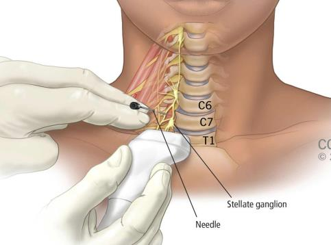 Stellate Ganglion blocks treatment for PTSD
