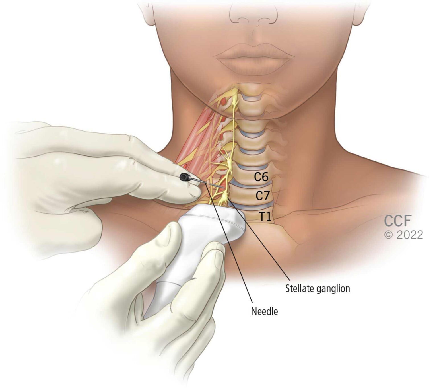 Stellate Ganglion block and PTSD and Post trauamtic stress disorder